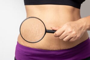 What is cellulite and how to get rid of it