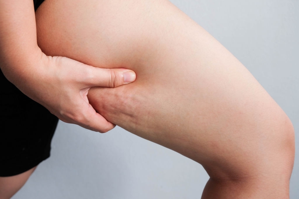 myths about cellulite